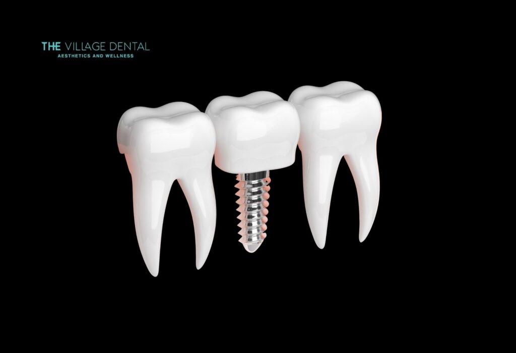 Single tooth implant with titanium post and custom crown, representing restorative dentistry at The Village Dental in Pinecrest, FL.